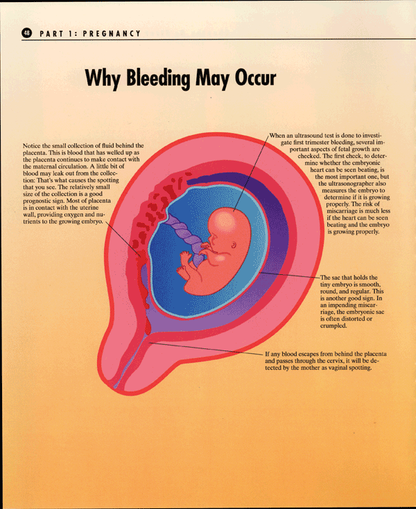 First Trimester Bleeding Image 1